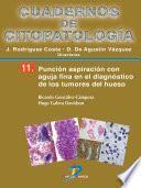 Punción aspiración con aguja fina en el diagnóstico de los tumores de hueso